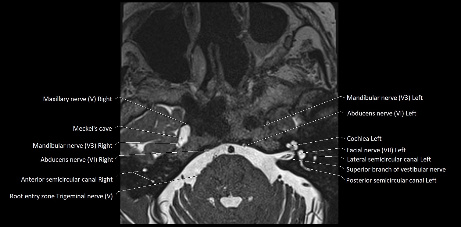 Cranial nerve anatomy axial MRI 3T image 49.webp
